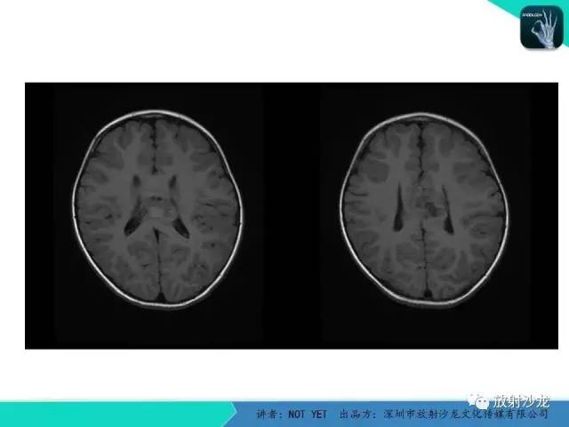 【病例】节细胞胶质瘤1例MR影像表现