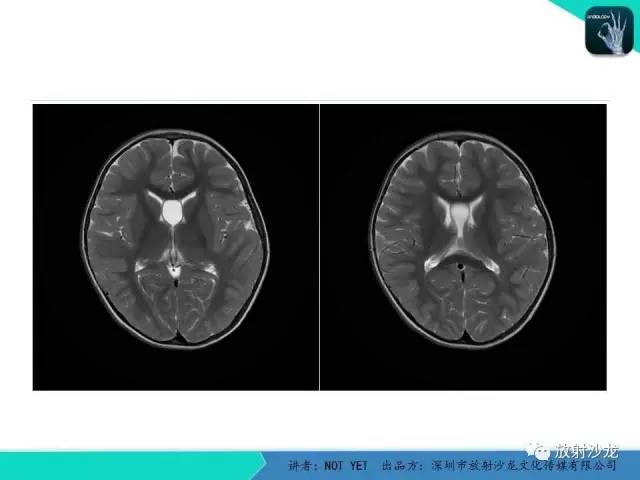 【病例】节细胞胶质瘤1例MR影像表现