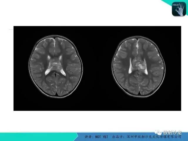 【病例】节细胞胶质瘤1例MR影像表现