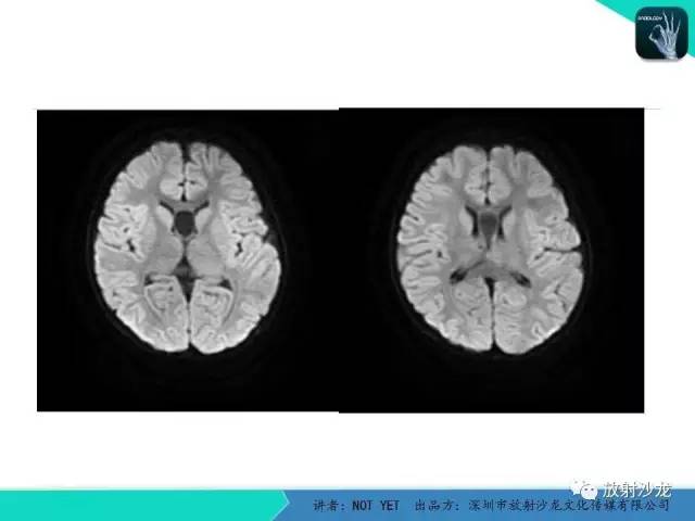 【病例】节细胞胶质瘤1例MR影像表现