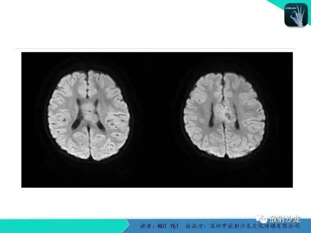【病例】节细胞胶质瘤1例MR影像表现