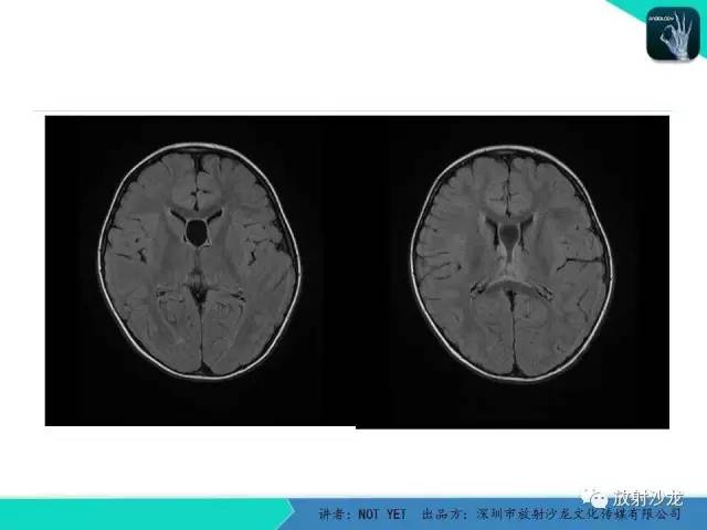 【病例】节细胞胶质瘤1例MR影像表现