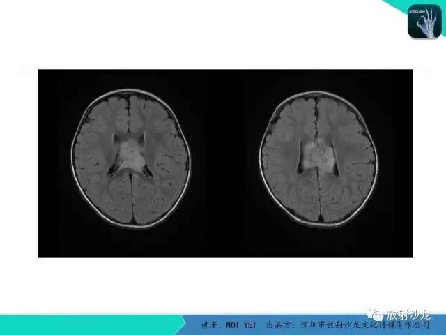 【病例】节细胞胶质瘤1例MR影像表现