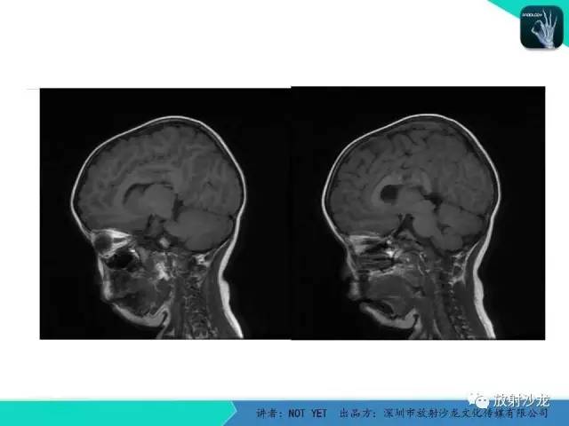 【病例】节细胞胶质瘤1例MR影像表现