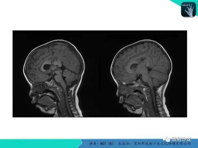【病例】节细胞胶质瘤1例MR影像表现