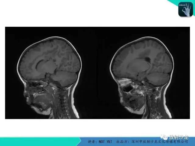 【病例】节细胞胶质瘤1例MR影像表现