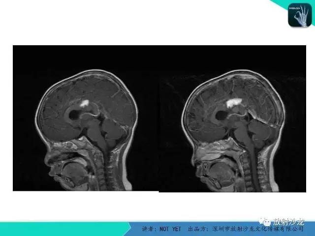 【病例】节细胞胶质瘤1例MR影像表现