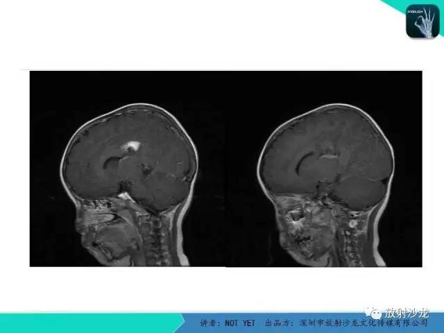 【病例】节细胞胶质瘤1例MR影像表现