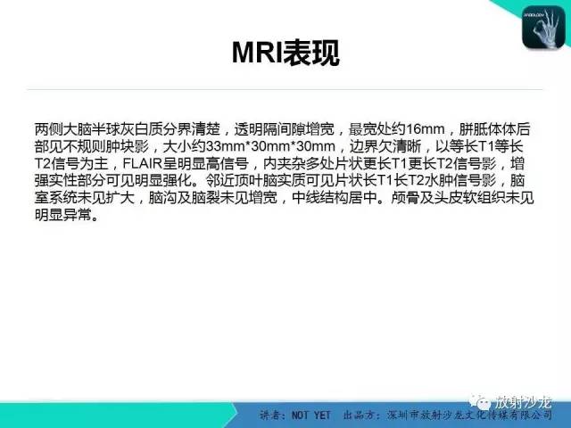【病例】节细胞胶质瘤1例MR影像表现