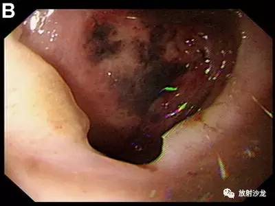 【病例】十二指肠溃疡破入肝脏1例CT 【病例】十二指肠溃疡破入肝脏1例CT