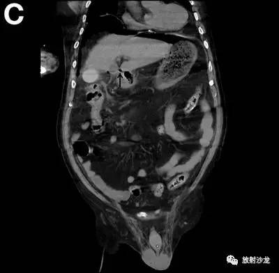 【病例】十二指肠溃疡破入肝脏1例CT