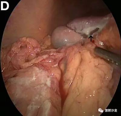 【病例】十二指肠溃疡破入肝脏1例CT 【病例】十二指肠溃疡破入肝脏1例CT