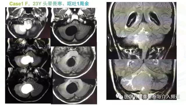 【PPT】中枢血管母细胞瘤的影像表现及鉴别诊断