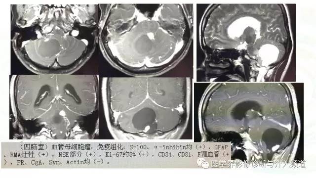 【PPT】中枢血管母细胞瘤的影像表现及鉴别诊断
