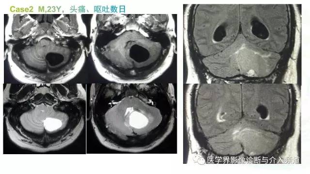 【PPT】中枢血管母细胞瘤的影像表现及鉴别诊断