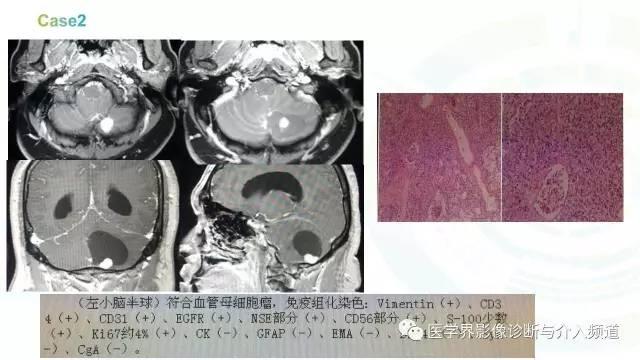 【PPT】中枢血管母细胞瘤的影像表现及鉴别诊断