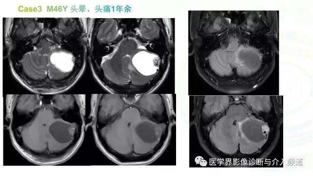 【PPT】中枢血管母细胞瘤的影像表现及鉴别诊断