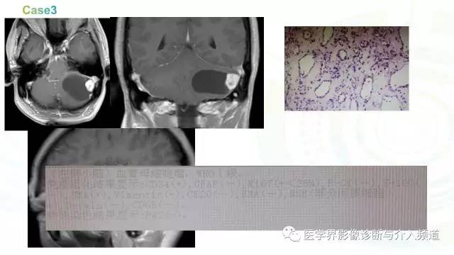 【PPT】中枢血管母细胞瘤的影像表现及鉴别诊断