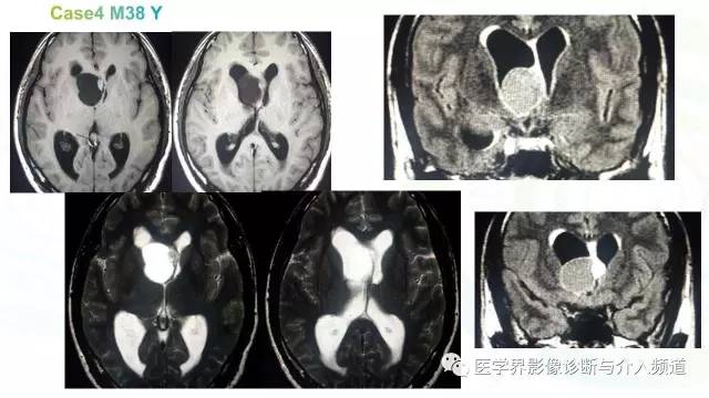【PPT】中枢血管母细胞瘤的影像表现及鉴别诊断