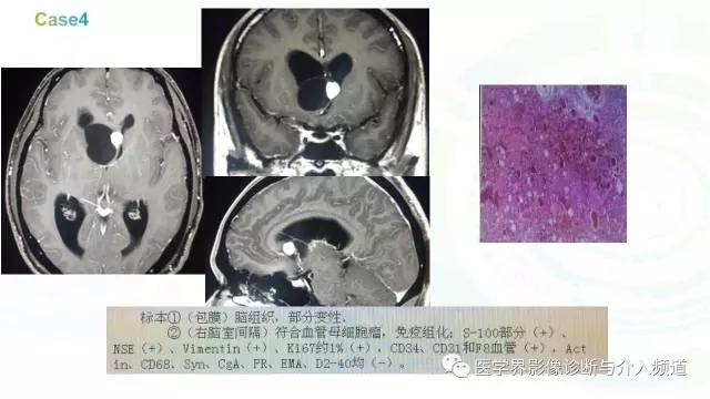 【PPT】中枢血管母细胞瘤的影像表现及鉴别诊断