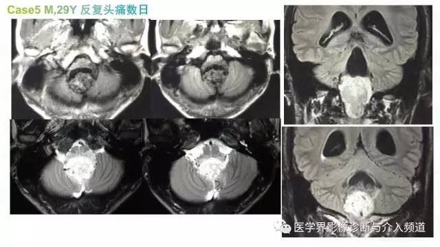 【PPT】中枢血管母细胞瘤的影像表现及鉴别诊断