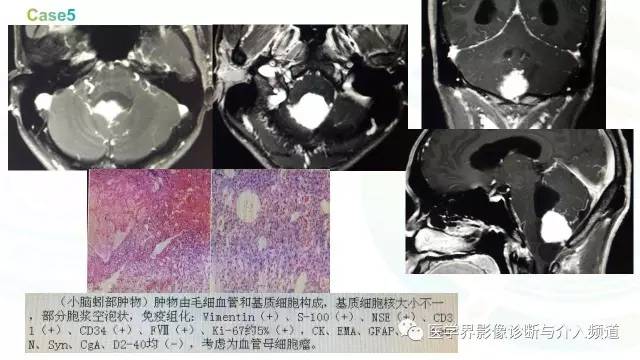 【PPT】中枢血管母细胞瘤的影像表现及鉴别诊断
