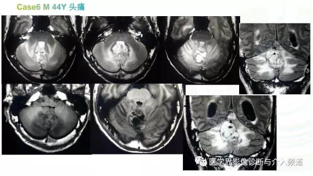 【PPT】中枢血管母细胞瘤的影像表现及鉴别诊断