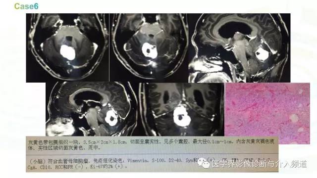 【PPT】中枢血管母细胞瘤的影像表现及鉴别诊断