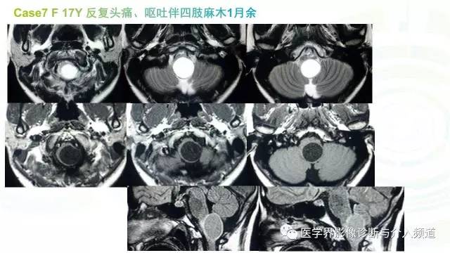 【PPT】中枢血管母细胞瘤的影像表现及鉴别诊断