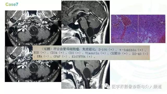 【PPT】中枢血管母细胞瘤的影像表现及鉴别诊断