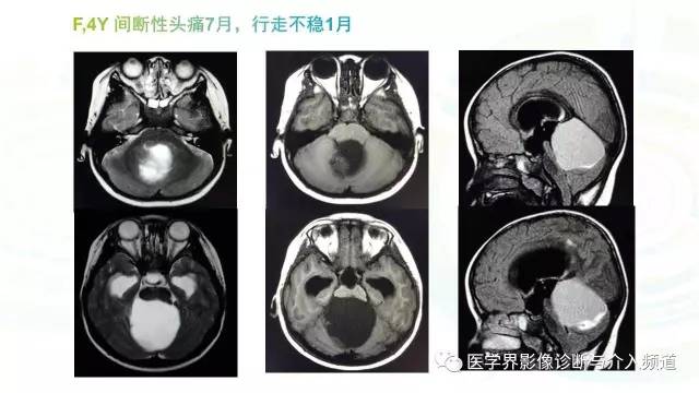 【PPT】中枢血管母细胞瘤的影像表现及鉴别诊断