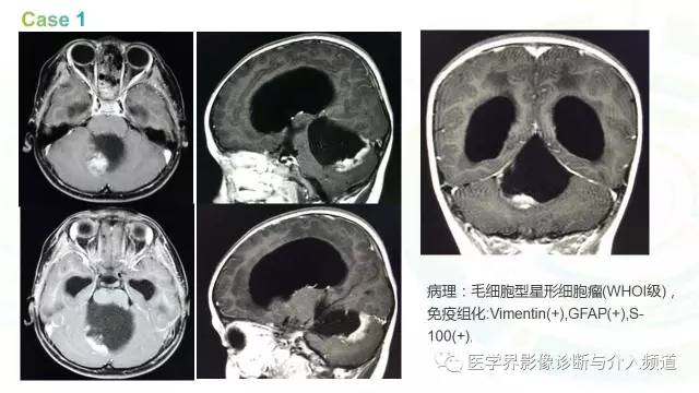 【PPT】中枢血管母细胞瘤的影像表现及鉴别诊断