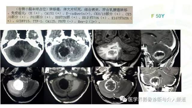 【PPT】中枢血管母细胞瘤的影像表现及鉴别诊断