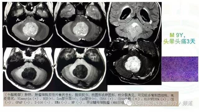 【PPT】中枢血管母细胞瘤的影像表现及鉴别诊断