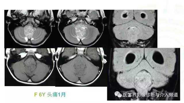 【PPT】中枢血管母细胞瘤的影像表现及鉴别诊断