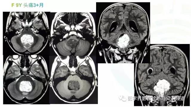 【PPT】中枢血管母细胞瘤的影像表现及鉴别诊断