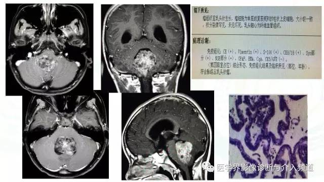 【PPT】中枢血管母细胞瘤的影像表现及鉴别诊断