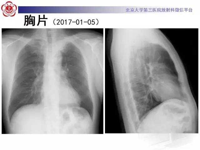 【病例】左肺尖神经内分泌癌1例CT影像表现