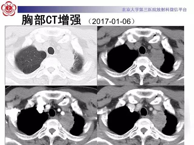 【病例】左肺尖神经内分泌癌1例CT影像表现