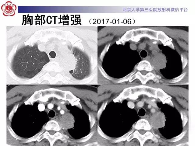 【病例】左肺尖神经内分泌癌1例CT影像表现