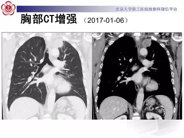 【病例】左肺尖神经内分泌癌1例CT影像表现