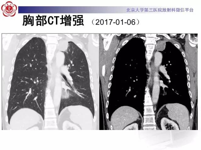 【病例】左肺尖神经内分泌癌1例CT影像表现