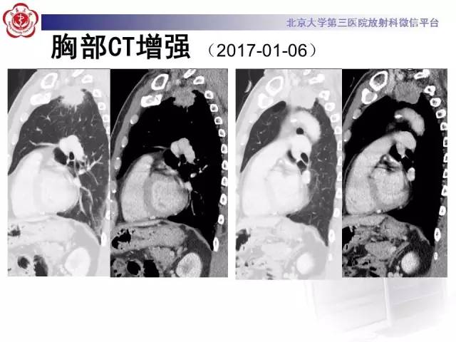 【病例】左肺尖神经内分泌癌1例CT影像表现
