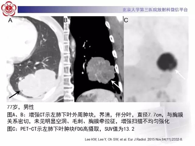【病例】左肺尖神经内分泌癌1例CT影像表现