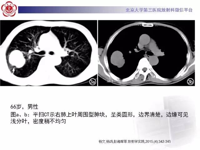 【病例】左肺尖神经内分泌癌1例CT影像表现