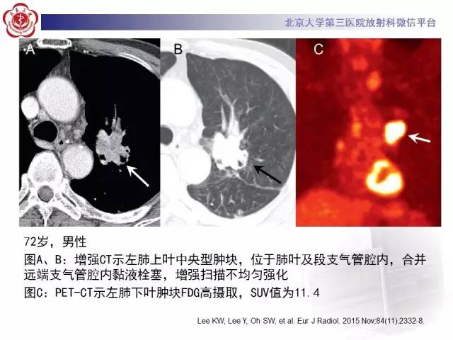【病例】左肺尖神经内分泌癌1例CT影像表现