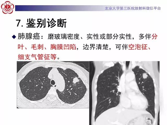 【病例】左肺尖神经内分泌癌1例CT影像表现