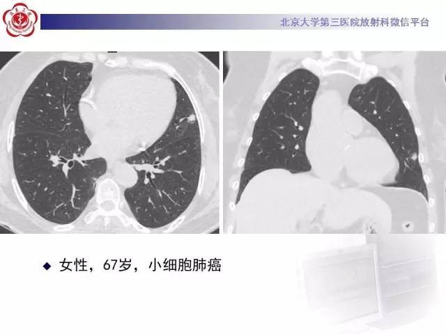 【病例】左肺尖神经内分泌癌1例CT影像表现