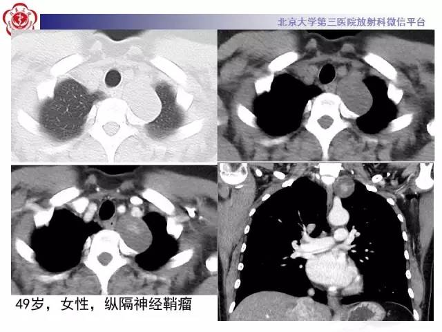 【病例】左肺尖神经内分泌癌1例CT影像表现