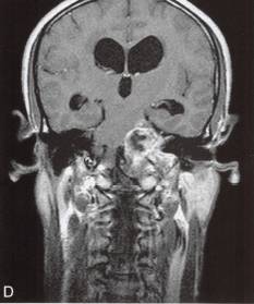 【病例】颈静脉孔区神经鞘瘤1例MR影像分析 【病例】颈静脉孔区神经鞘瘤1例MR影像分析